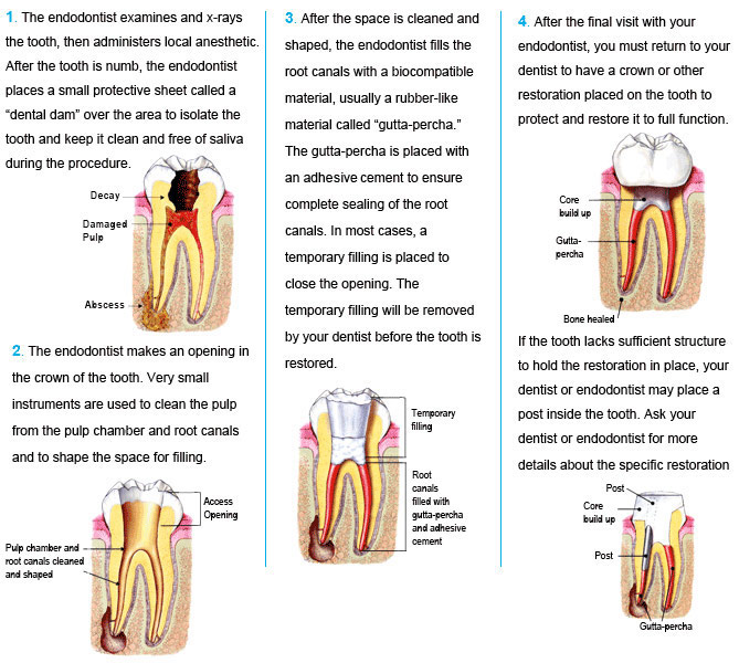 Endodontic Treatment Dr. Gamson