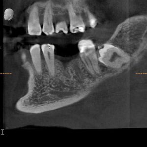 CBCT image